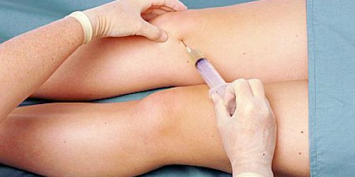 Arthrocentesis - Joint fluid aspiration